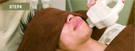 口下ヒゲ脱毛Step4
